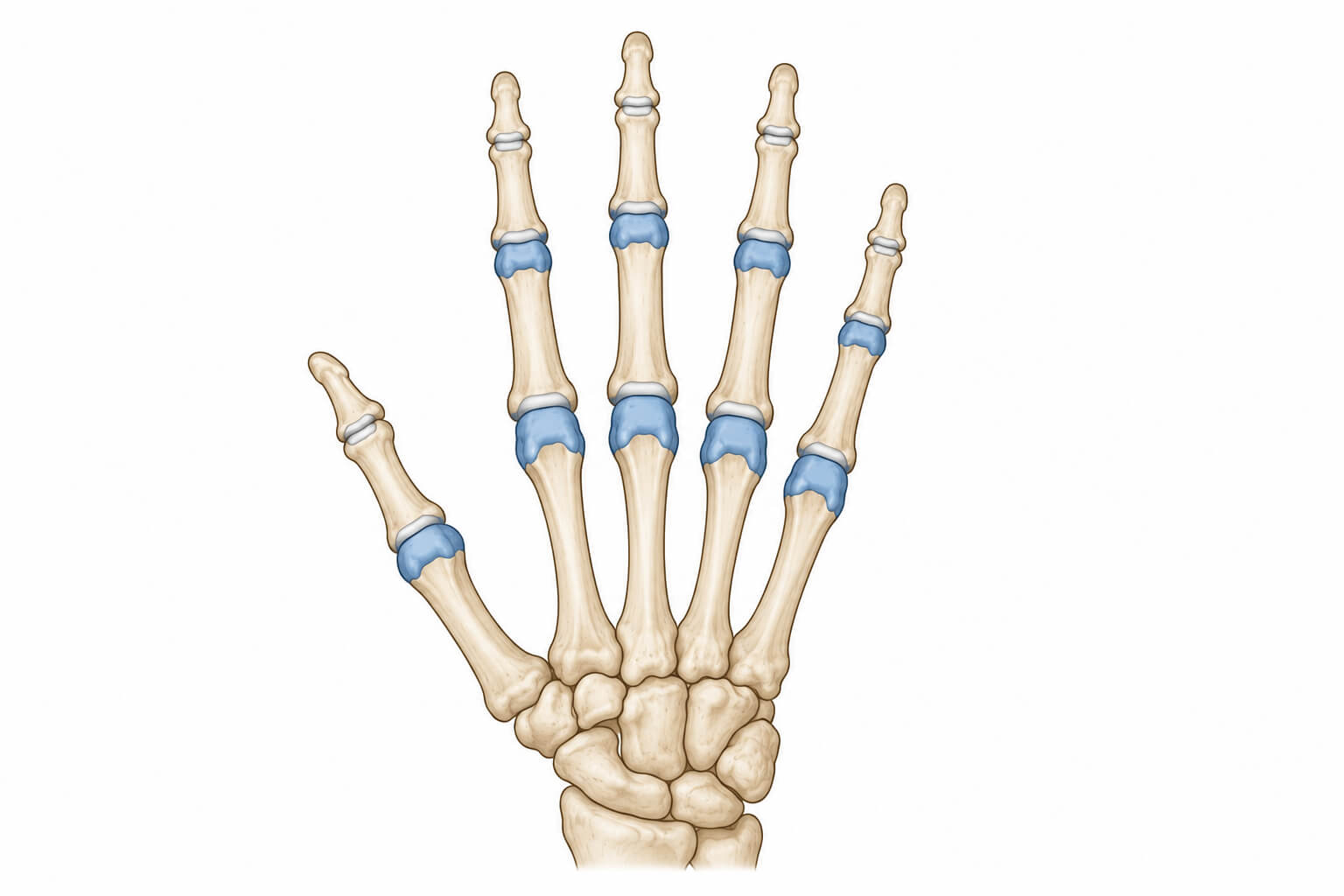 Diagram of hand joints affected by early rheumatoid arthritis — MCP and PIP joints, with fingertip DIP joints typically spared